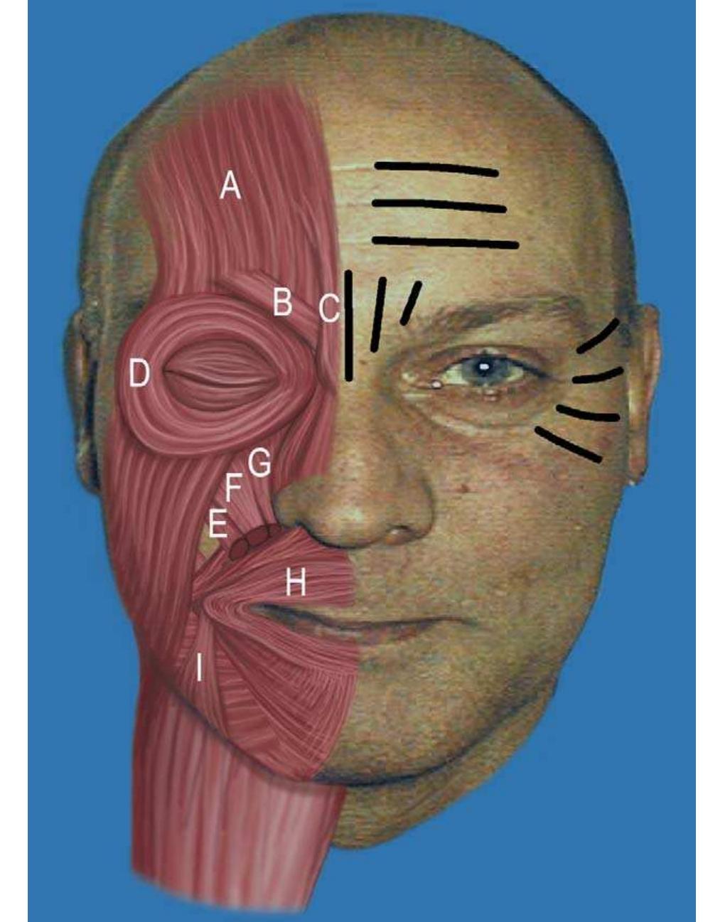 (PDF) The use of botulinum toxin type A in cosmetic facial procedures