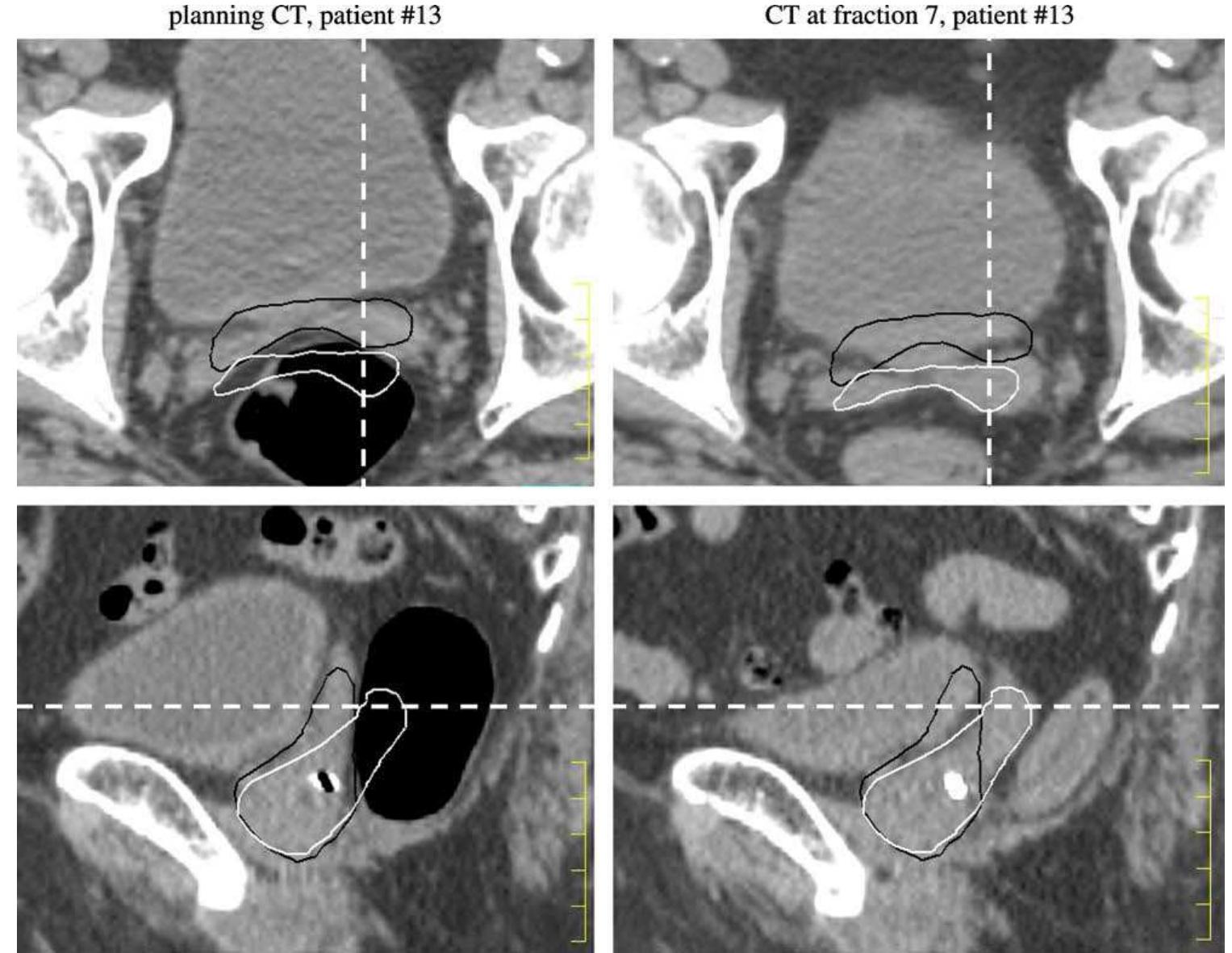 Ct Image Ruler Axial and sagittal images of (left) planning ct scan and