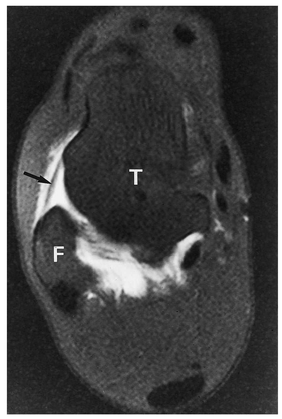 - mr arthrogram showing normal anterior talofibular