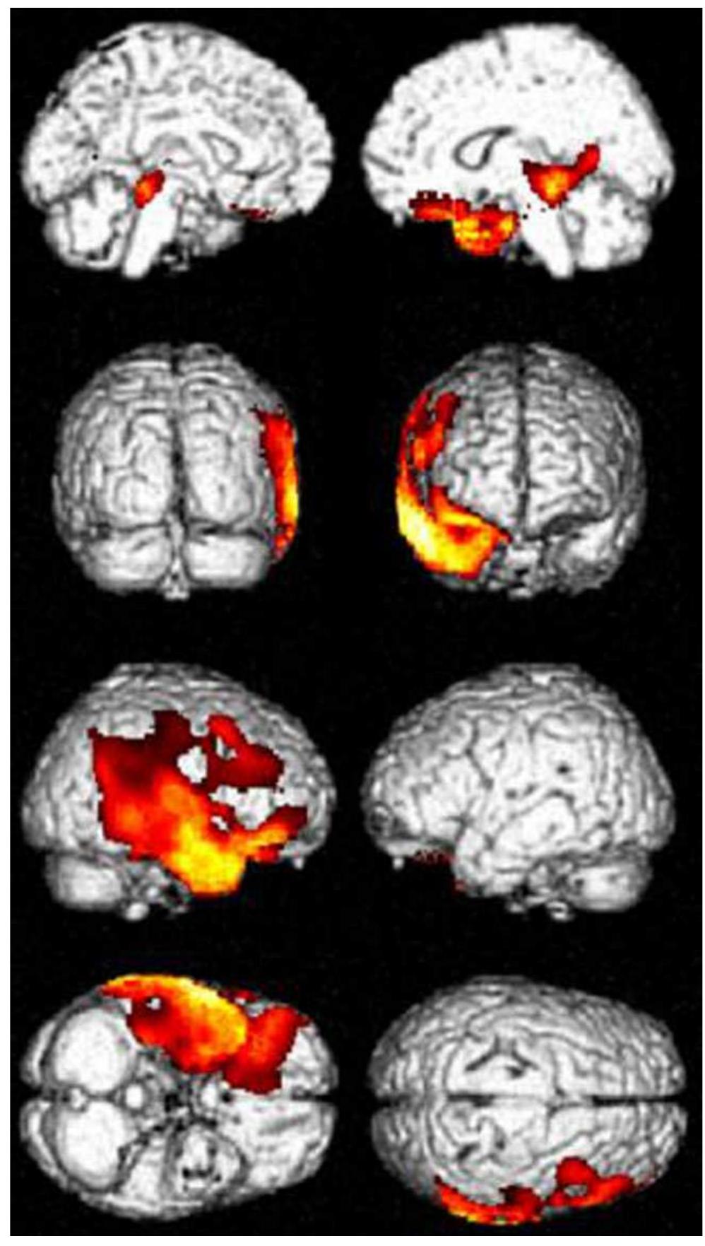 (PDF) 18 FDG-PET in different subtypes of temporal lobe epilepsy: SEEG ...
