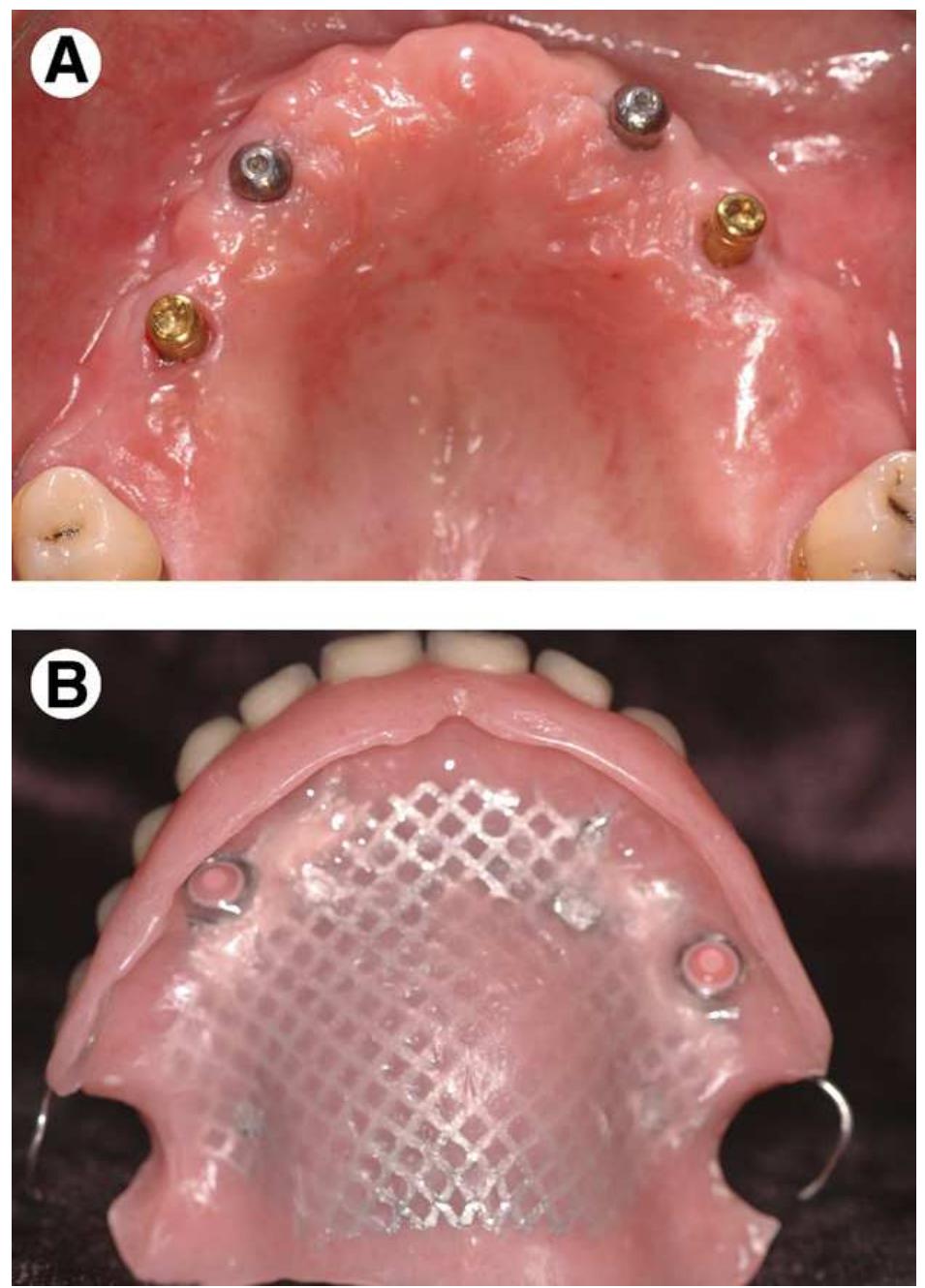 Maxillary Rpd Prosthesis Class Iv (PDF) Clinical Effectiveness of Implant-Supported Removable Partial ...