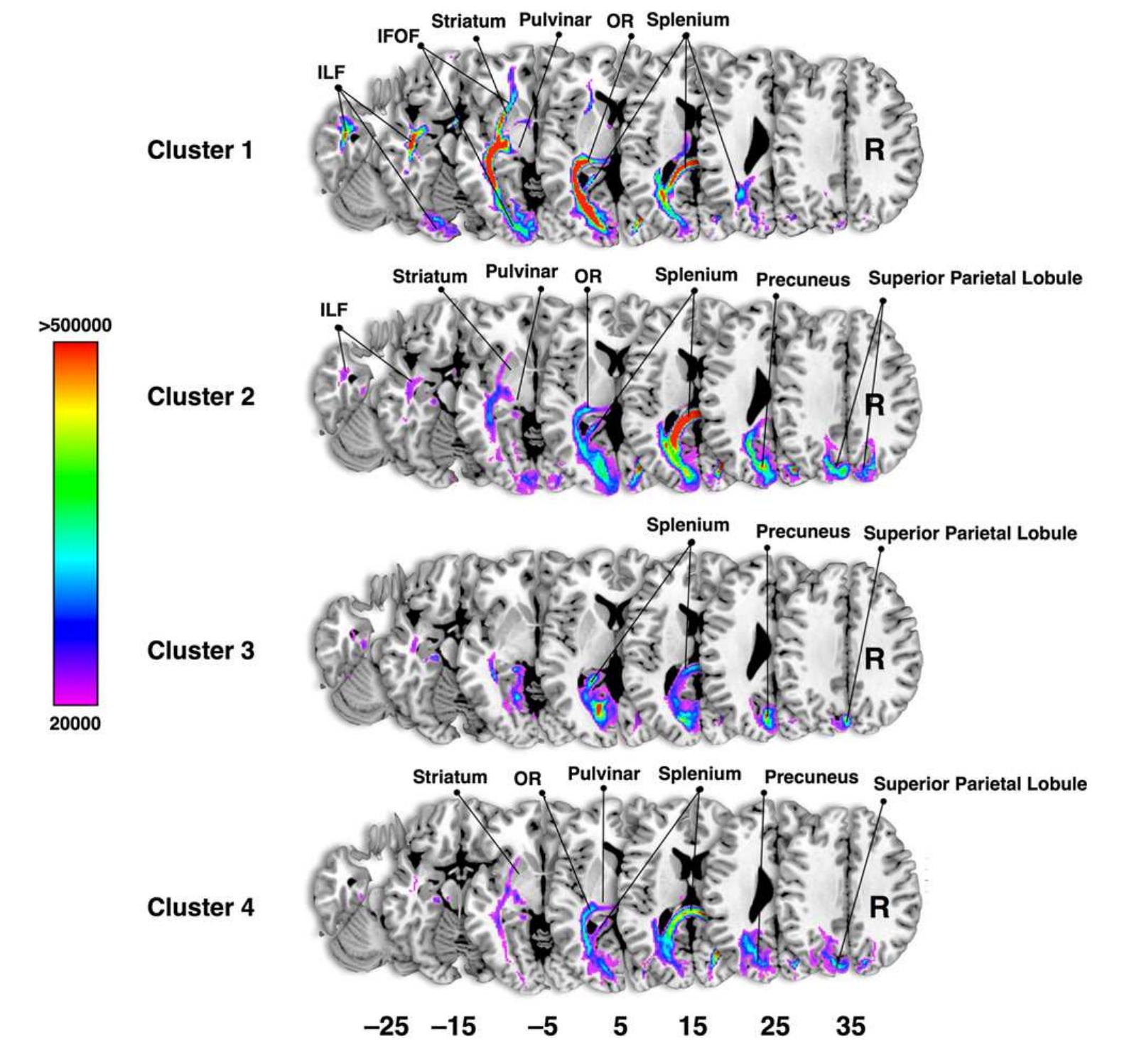 (PDF) Subdivision of the occipital lobes: An anatomical and functional ...