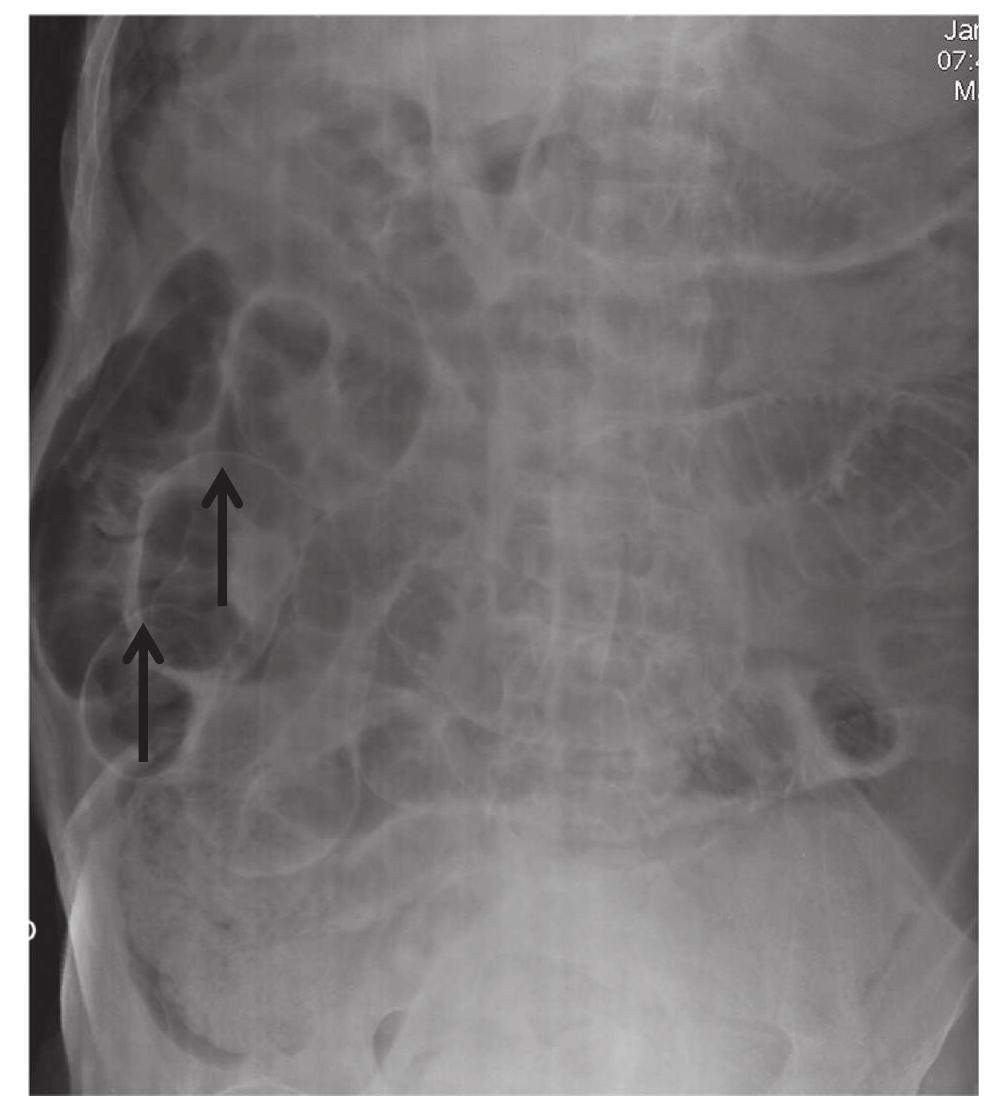 Plural Sign Radiograph Figure 1 - from Spectrum of Signs of Pneumoperitoneum