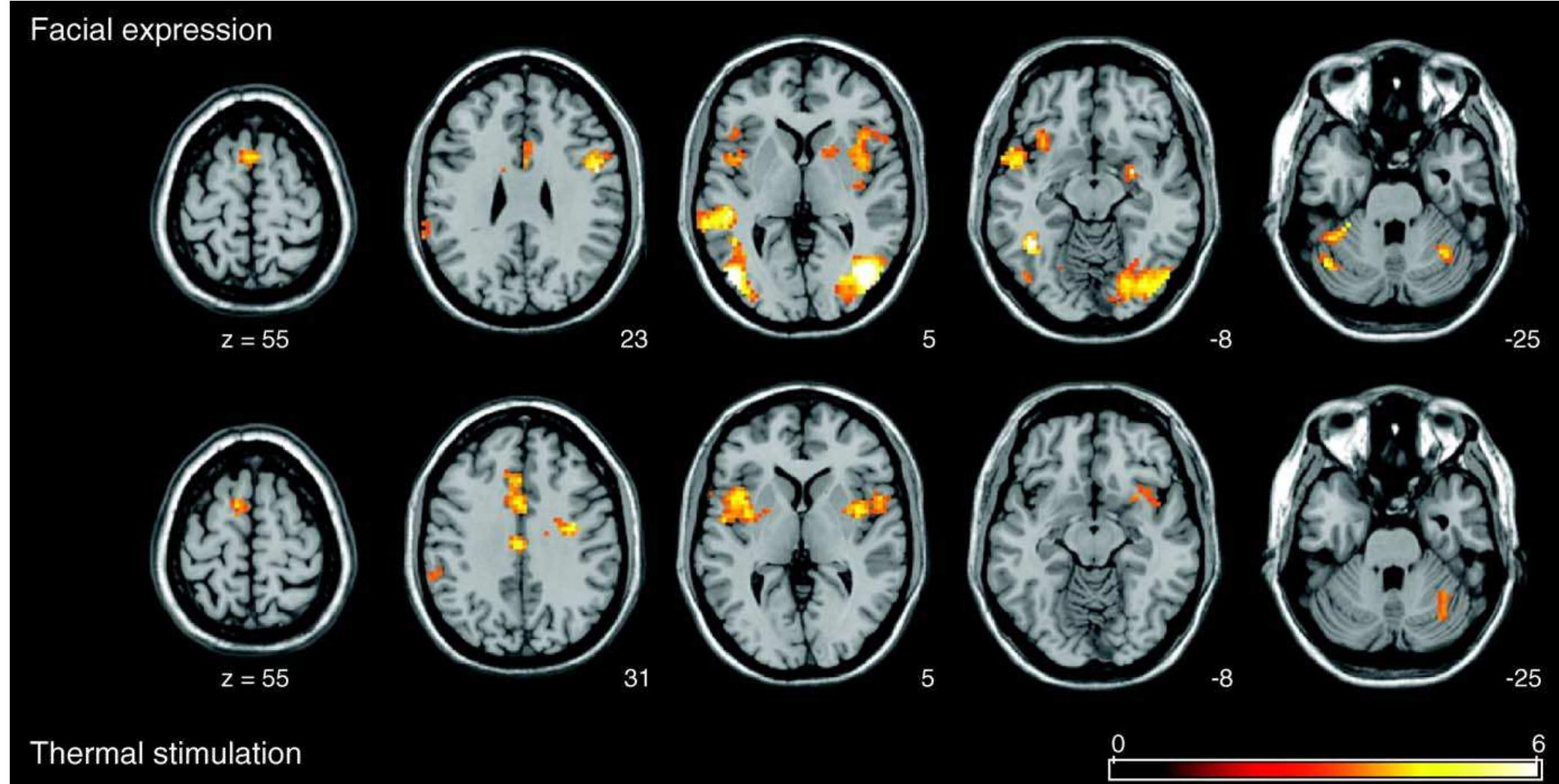 Pain Expression Visual (PDF) Viewing facial expressions of pain engages cortical areas ...