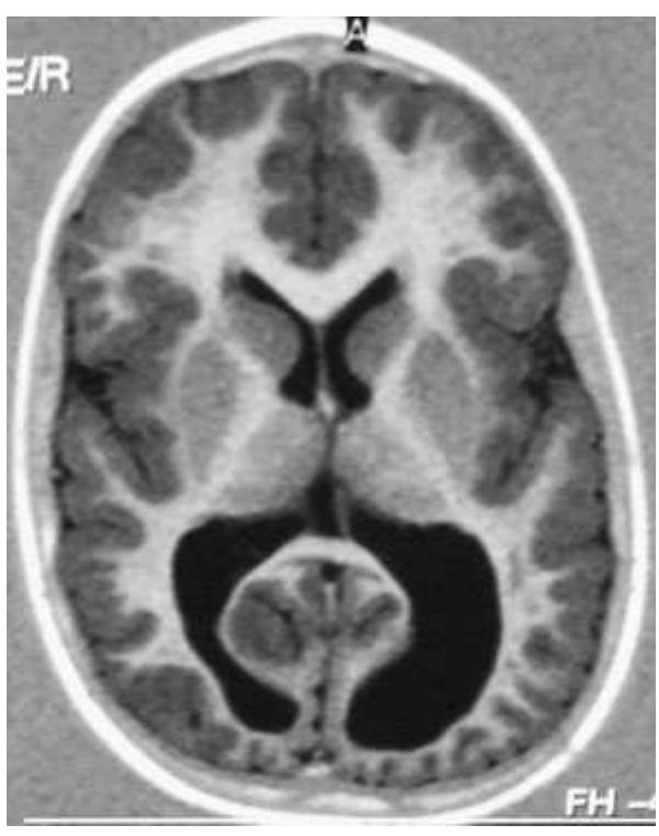 Mri tl-weighted axial scans showing diffuse bilateral