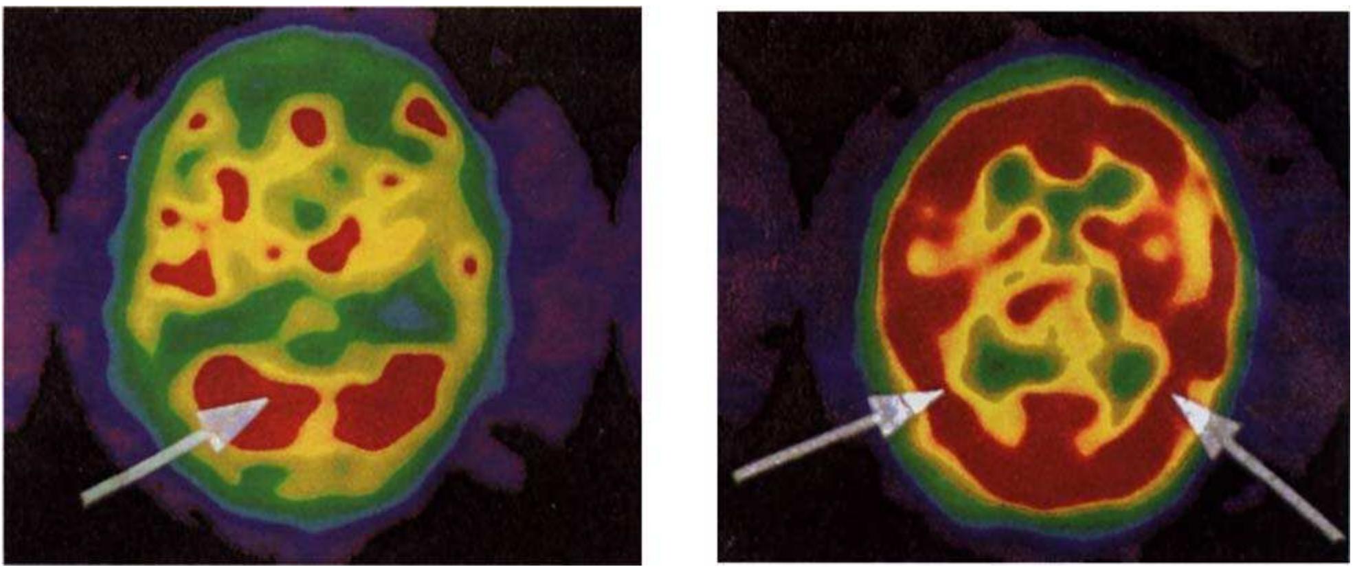 Discitis Ceretec Scan (PDF) Single photon emission and cerebral computerized tomographic scan ...