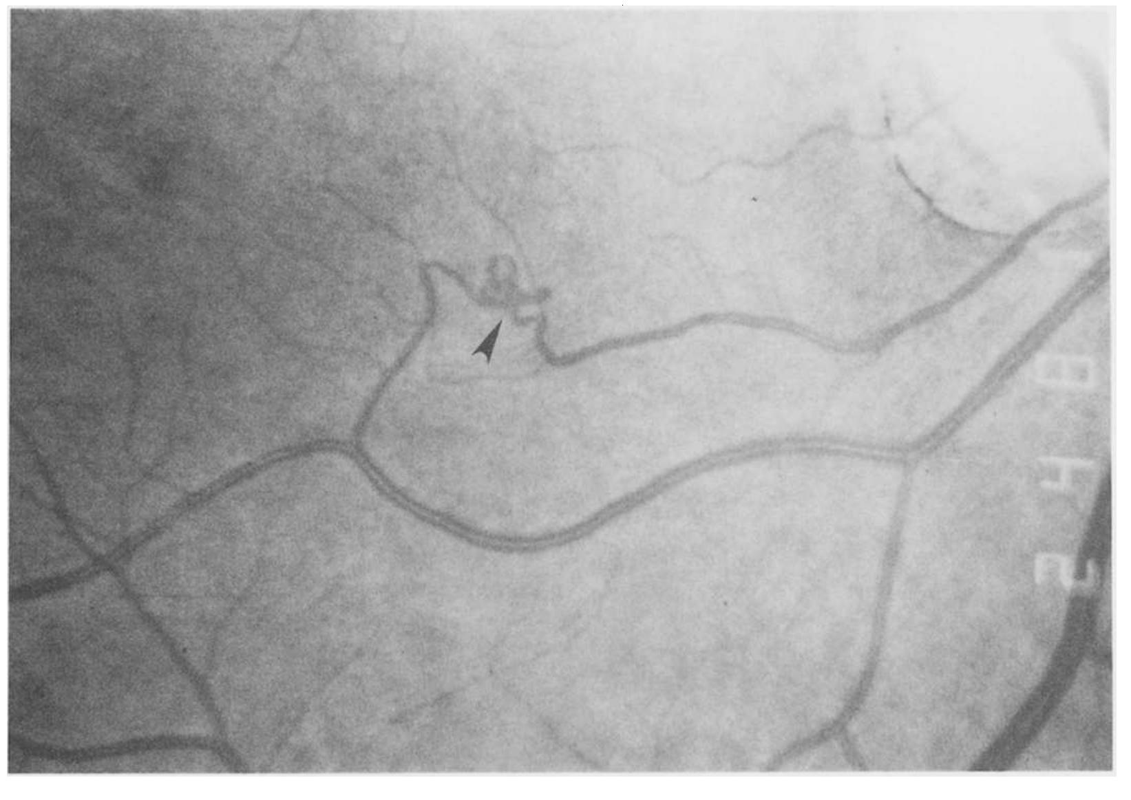 (PDF) Arteriovenous anastomoses of the retina
