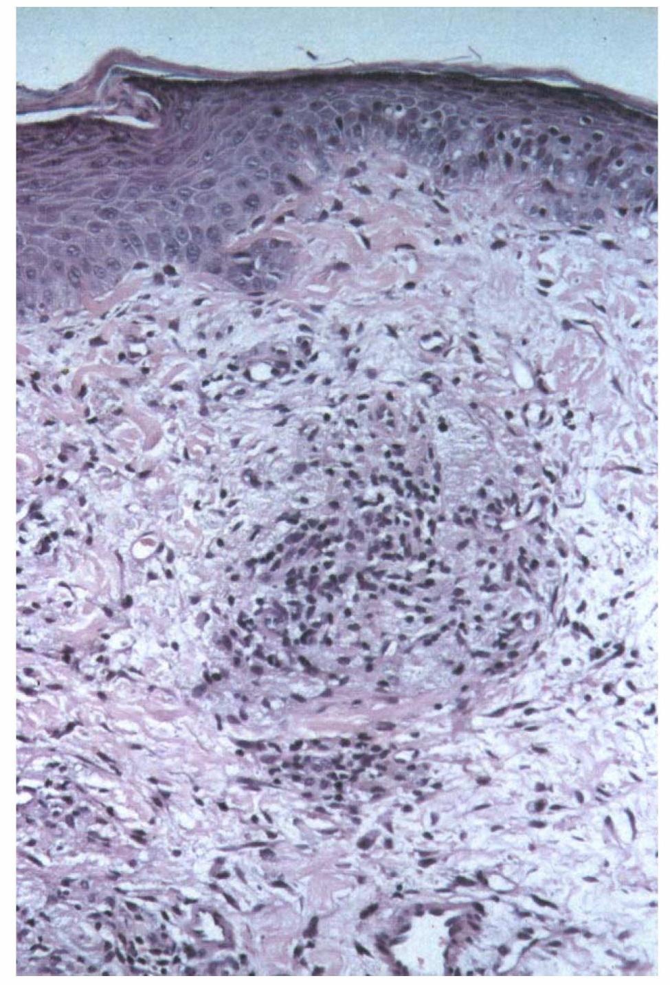 The post-laser appearances showing a diffuse chronic