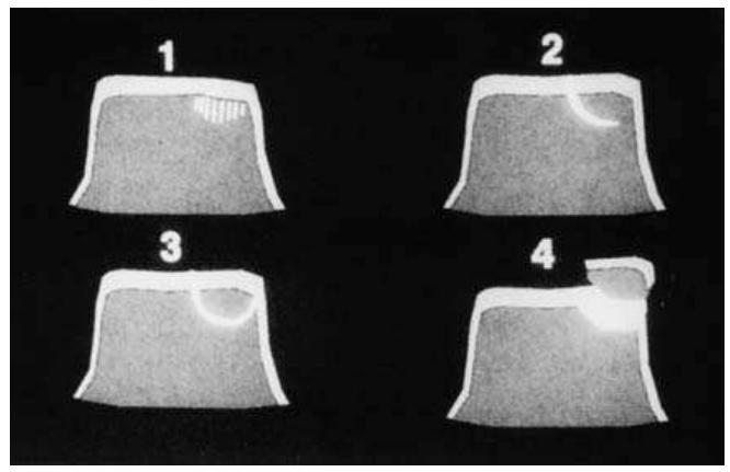 (PDF) [Osteochondral lesions of the talus]
