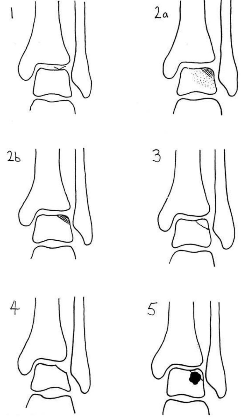 (PDF) [Osteochondral lesions of the talus]