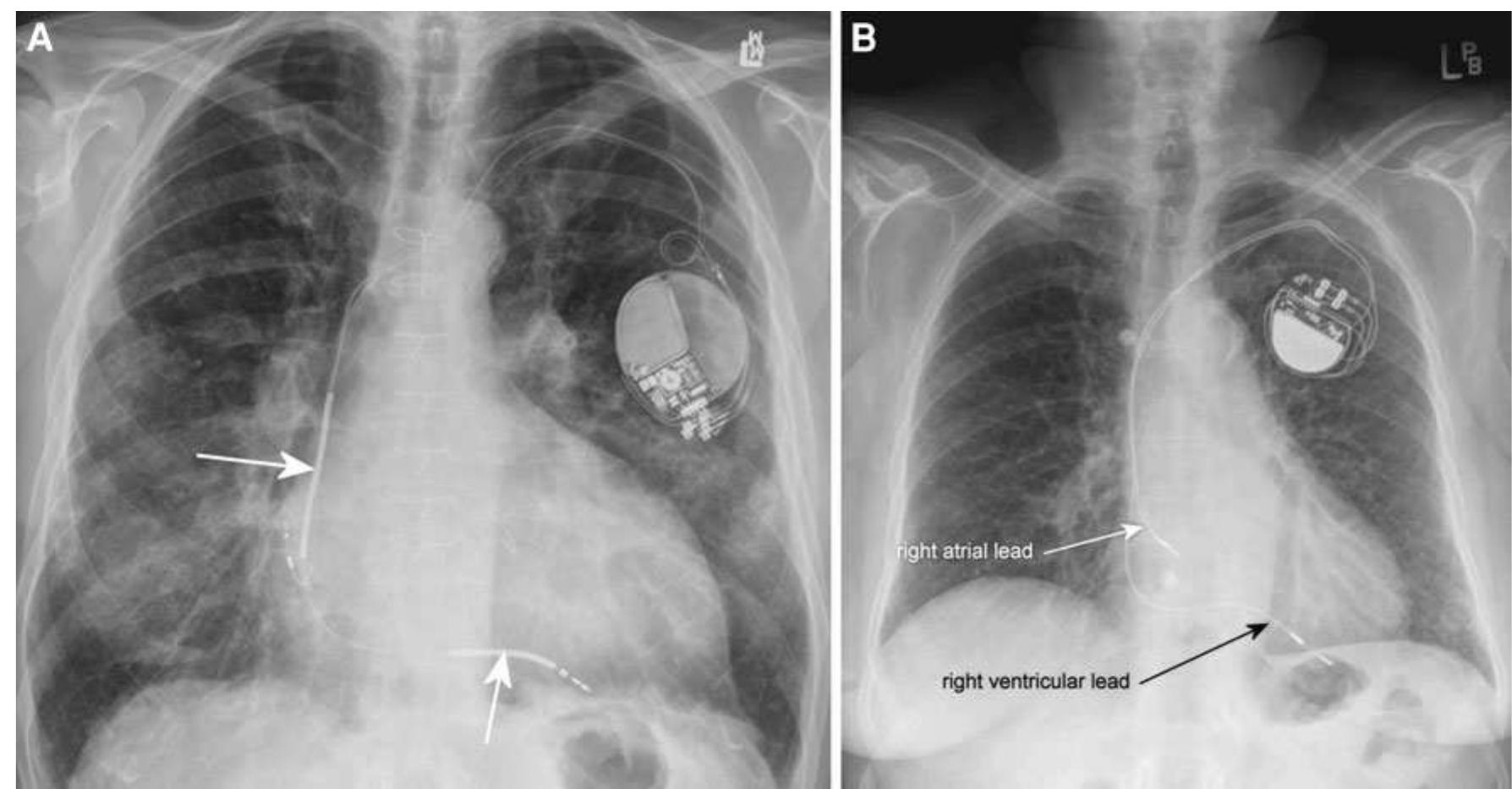 (a) electrocardiogram (ecg) showing intermittent right