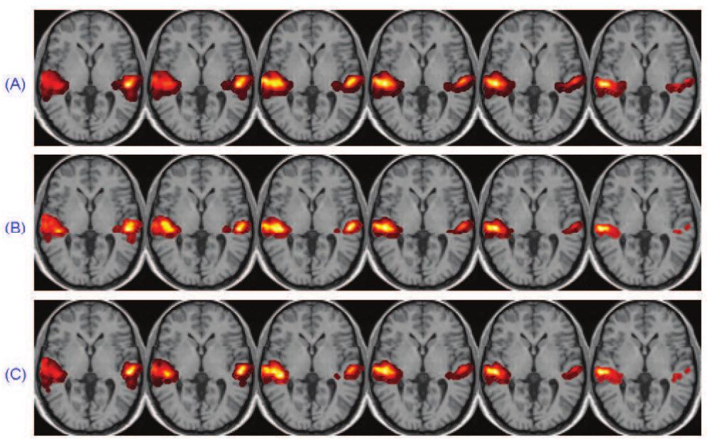 (PDF) A single SVD sparse dictionary learning algorithm for FMRI data ...