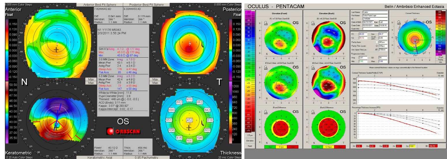 Posterior Float (PDF) Measurement and Topography Guided Treatment of Irregular Astigmatism