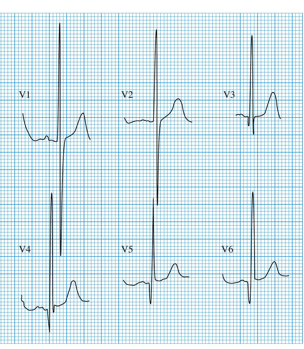 Defect Note Ventricular septal defect: note that all leads are half