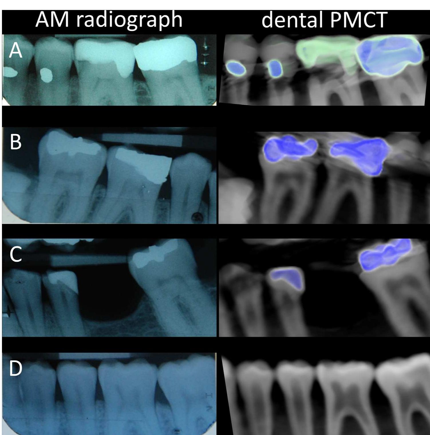 Figure 1 - from Validation of post mortem dental CT for
