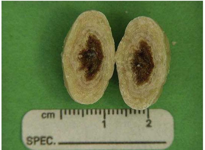 Suture as a foreign object nidus in a struvite urolith from