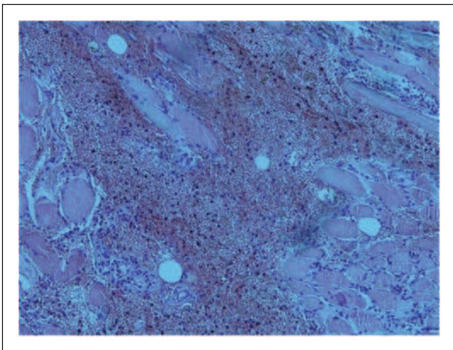 (PDF) Fatal laryngeal oedema in an adult from an air rifle injury, and ...