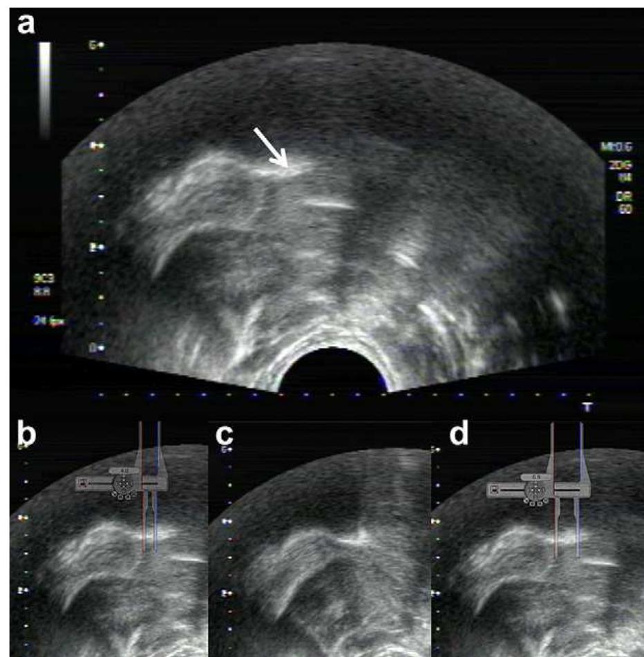 (PDF) Validation of Nipple Diameter and Tongue Movement Measurements ...