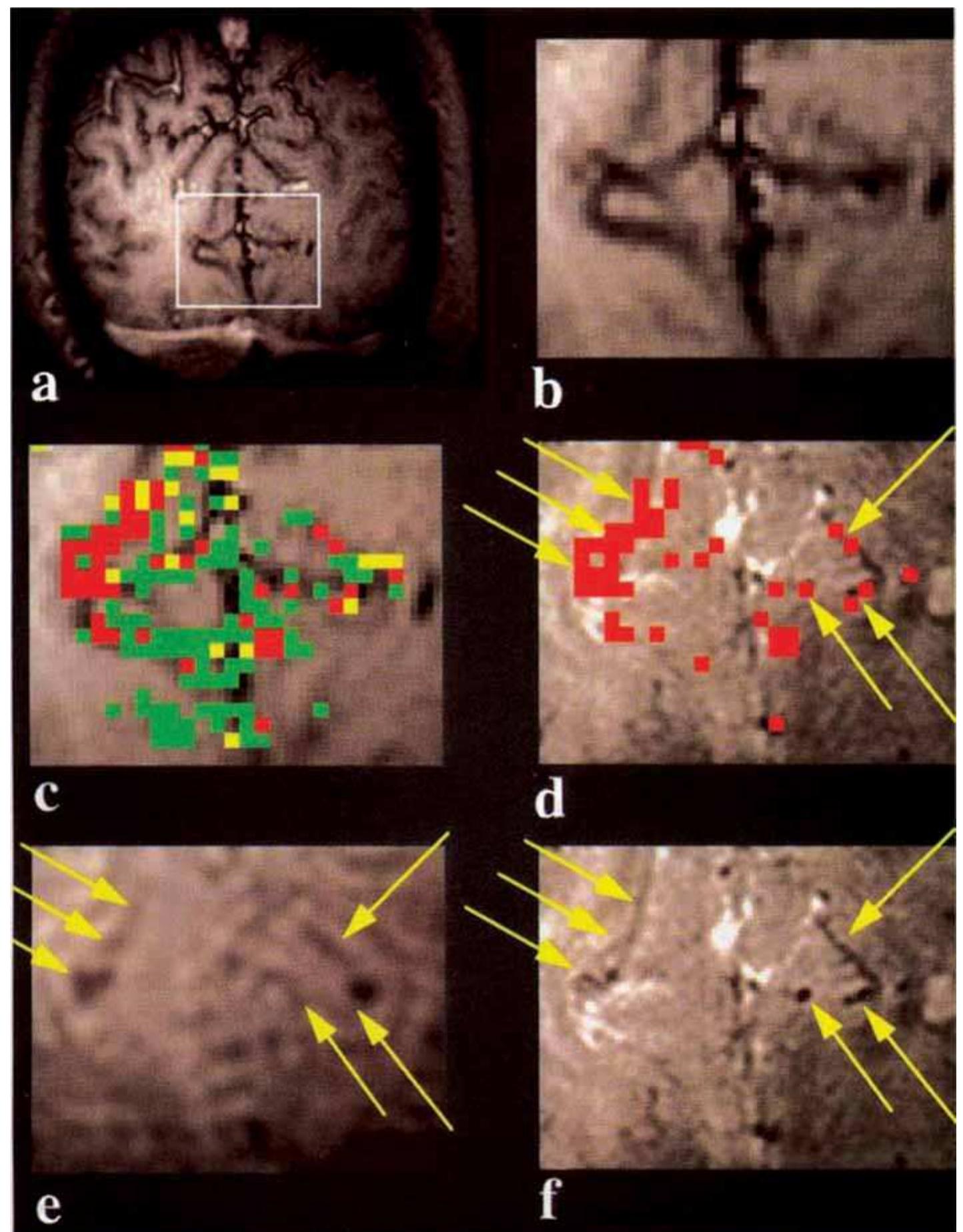 (PDF) Spatial and temporal differentiation of fMRI BOLD response in ...