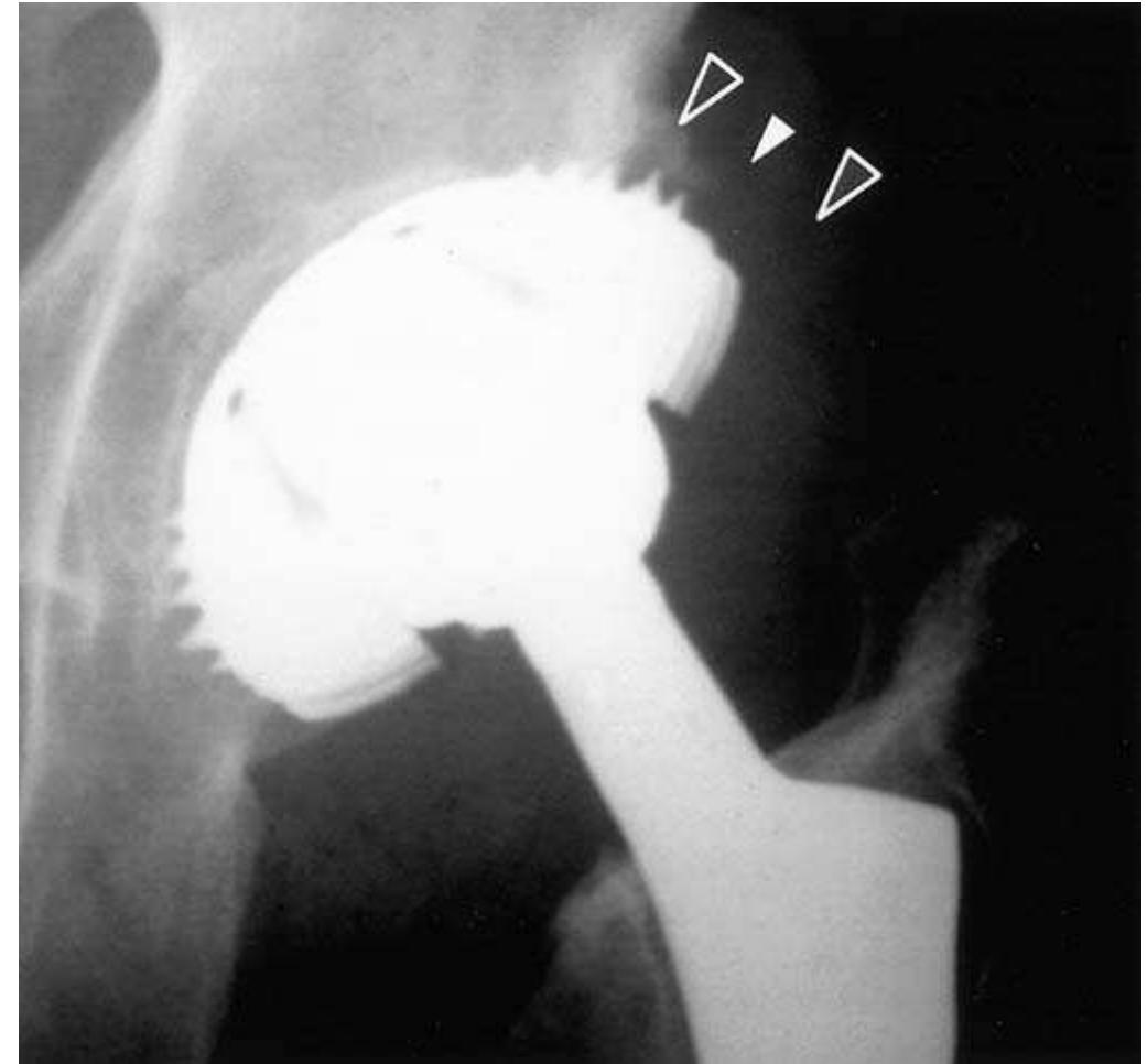 Figure 1 - from Ultrasound diagnosis of anterior iliopsoas