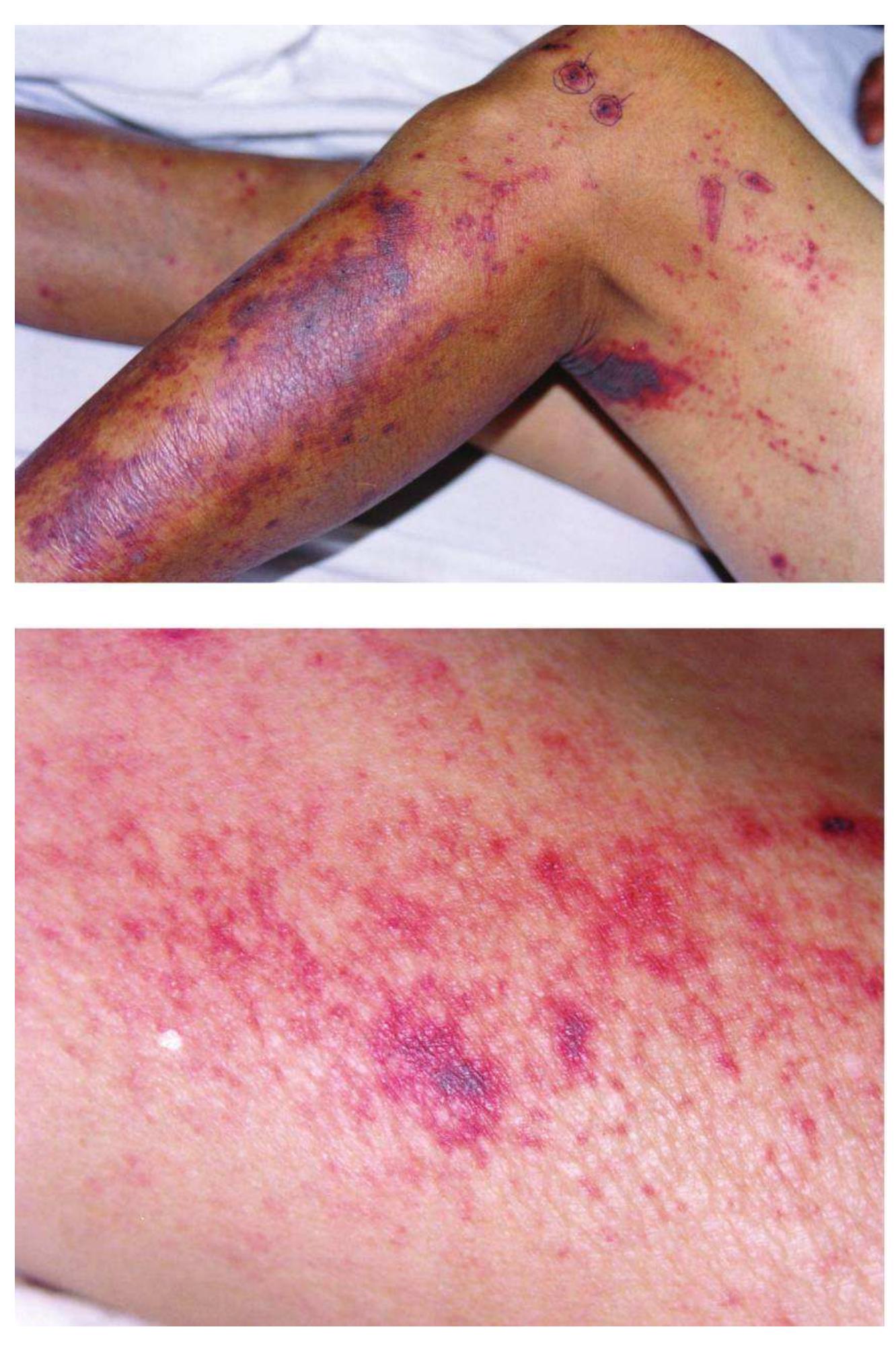 Figure 1 - from Streptococcus suis: An Emerging Human