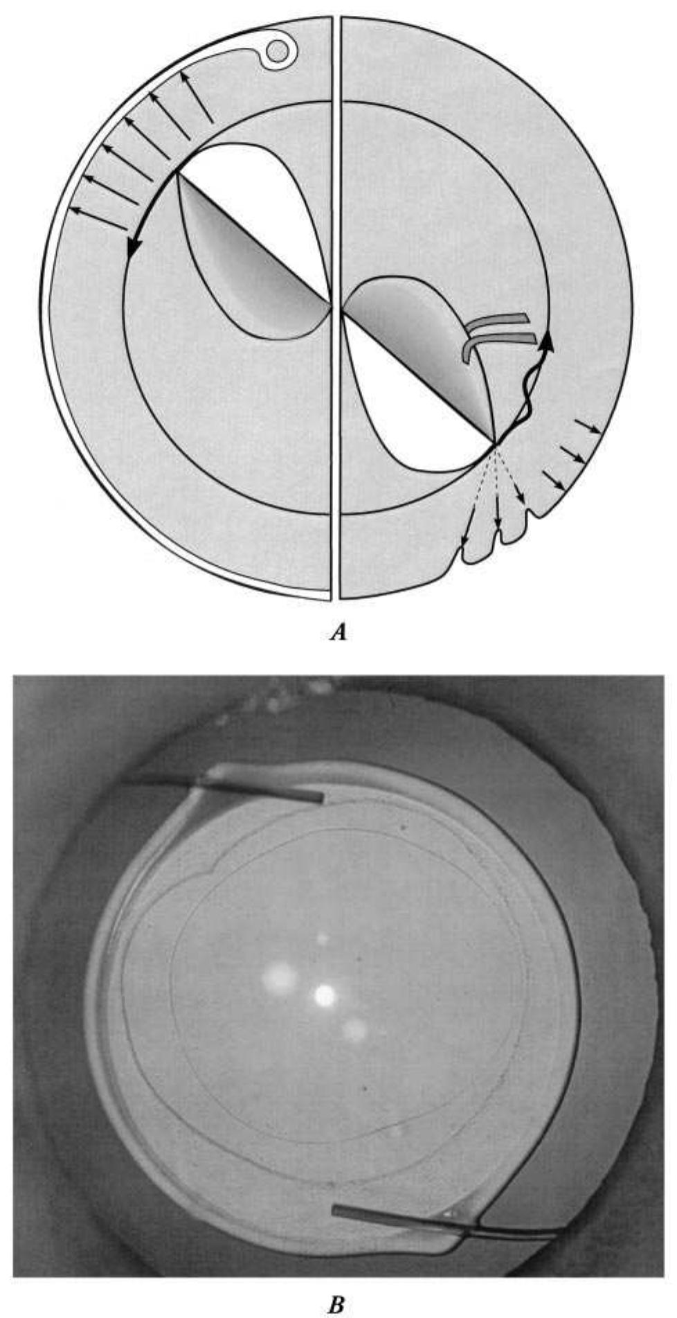 (PDF) The capsular tension ring: designs, applications, and techniques
