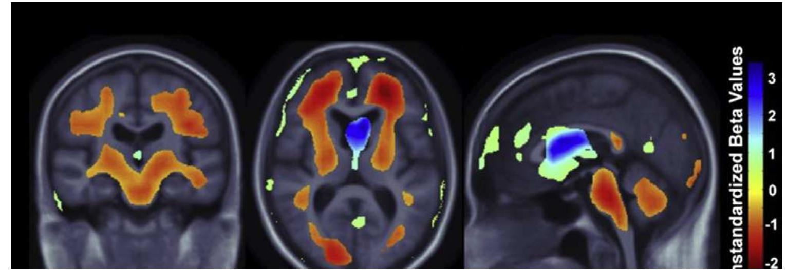 (PDF) The Alzheimer’s Disease Neuroimaging Initiative: A review of ...