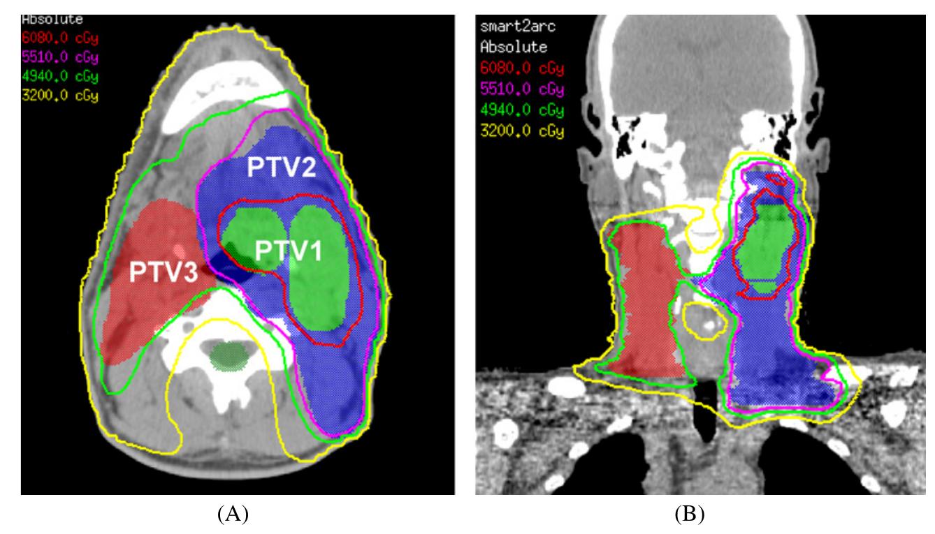 Isodose plot for the aperture-based vmat plan for a hn