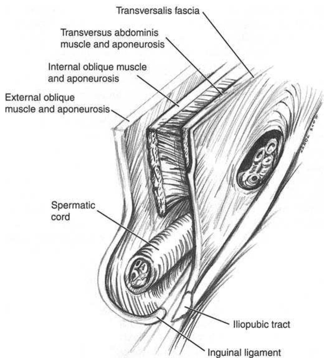 Triangular Protrusion Figure 31 - Hernias and Abdominal Wall Defects