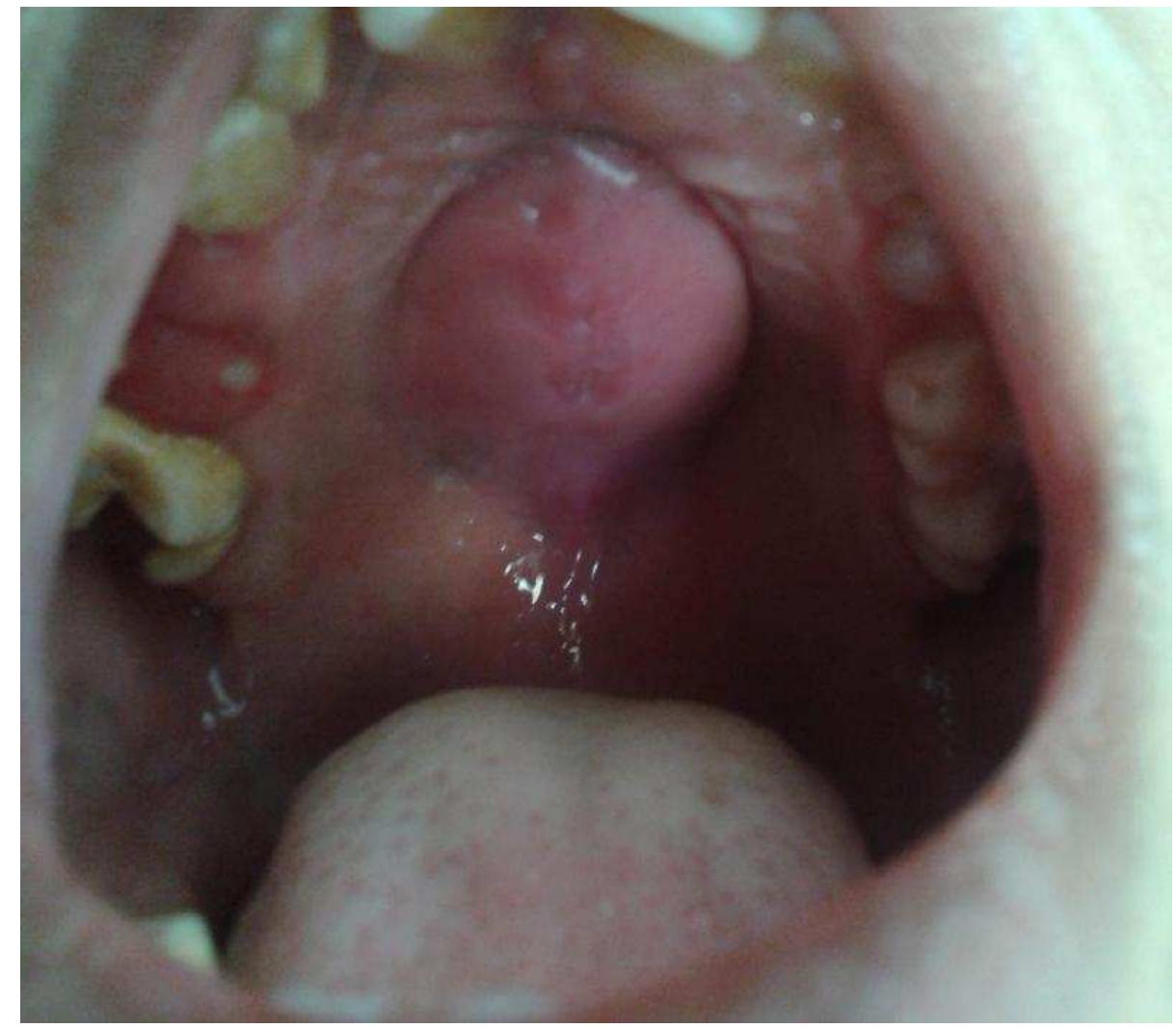 (PDF) A Report of a Rare Case of a Midline Palatal Abscess in a ...