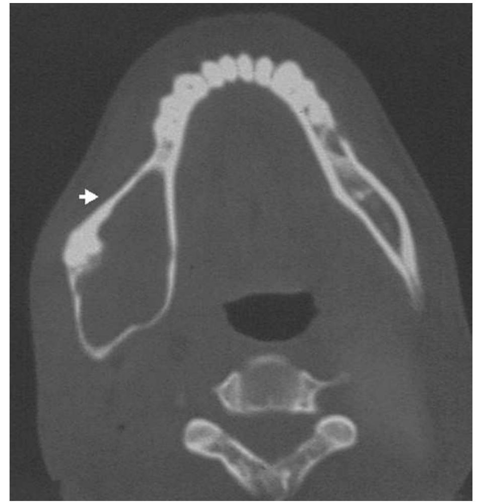 Computed tomography scan presenting buccal and lingual