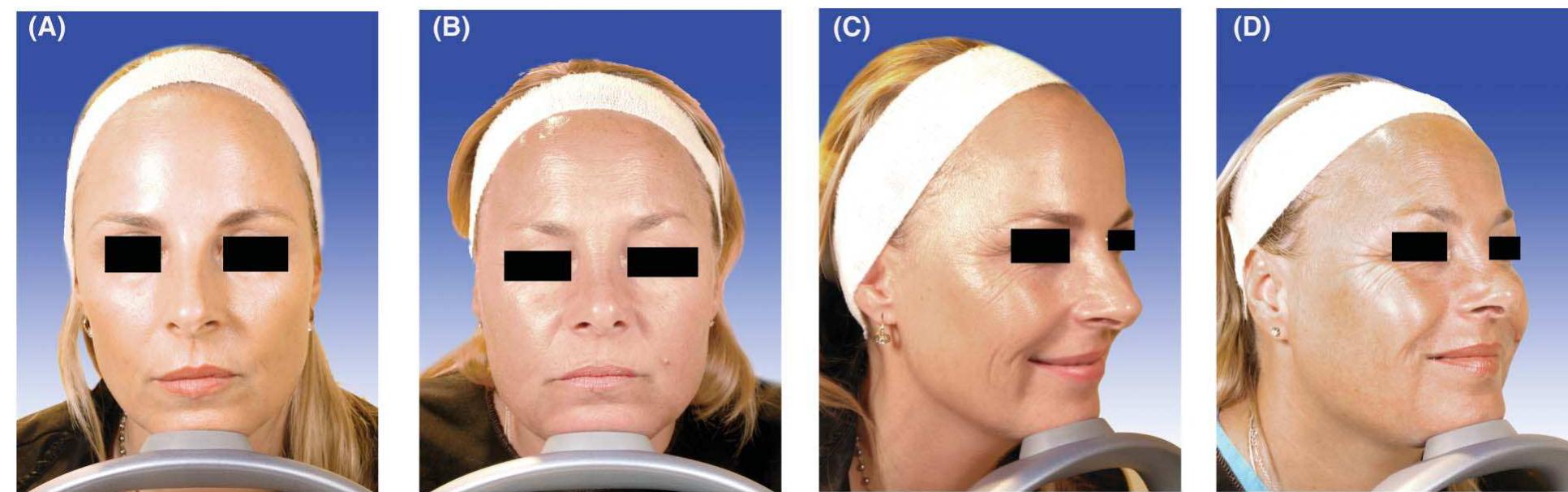 Static Rhytides (PDF) Long-term effects of onabotulinumtoxinA on facial lines: a 19 ...