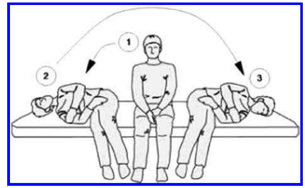Semont R Bppv (PDF) Management of benign paroxysmal positional vertigo (BPPV) in the ...