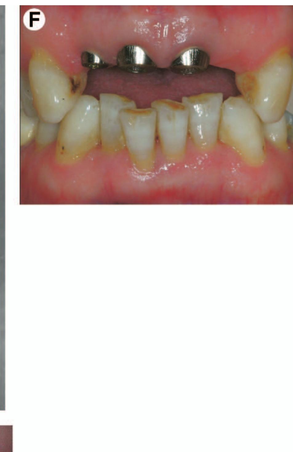 (PDF) Guidelines for Flapless Surgery