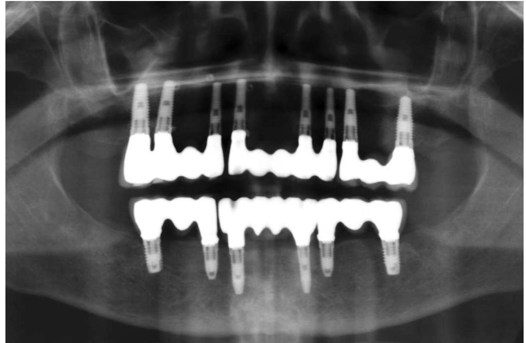 Parafunctional Forces Occlusal view of mandibular frameworks. zy frontal view in