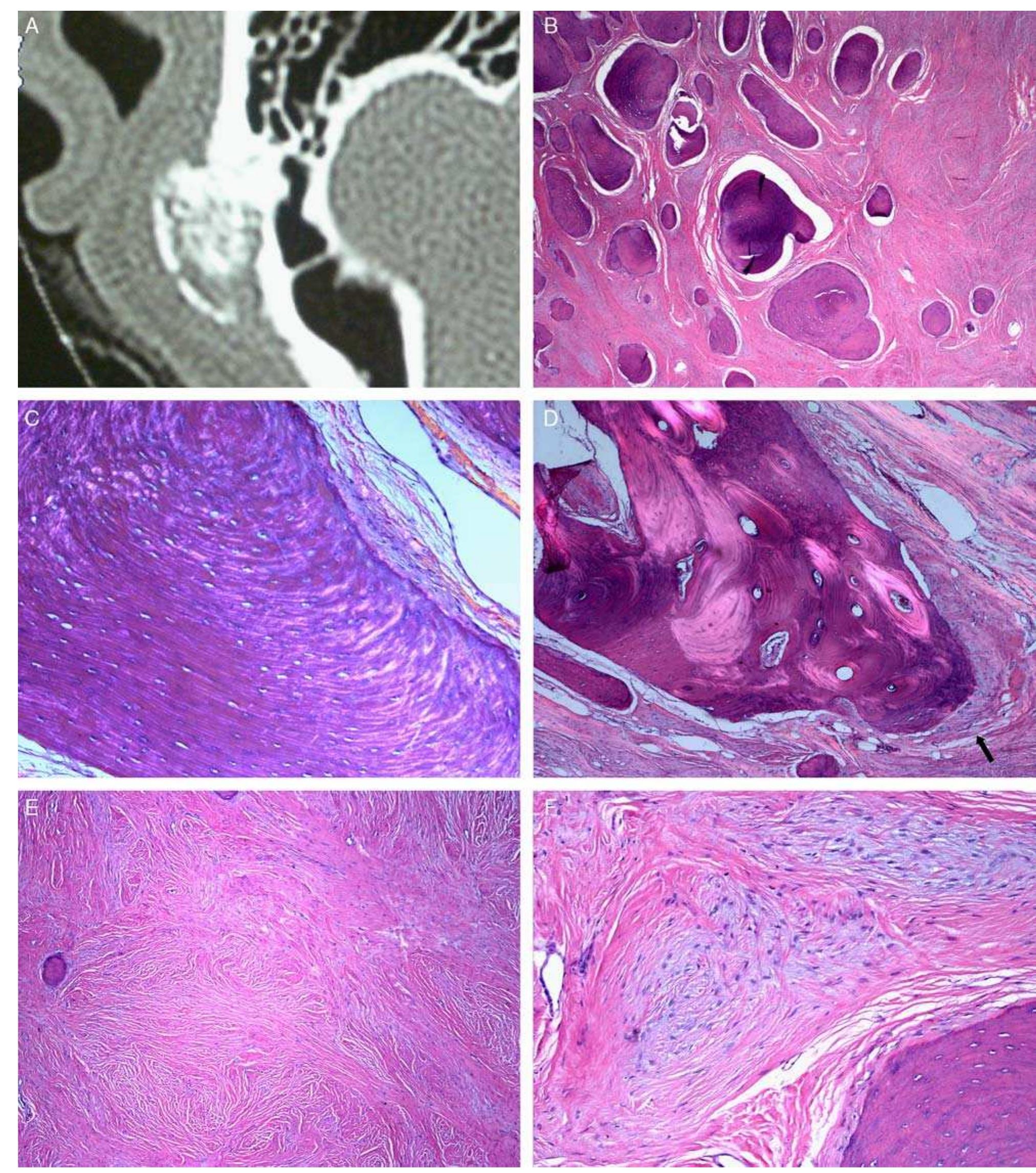 (PDF) Protuberant Fibro-osseous Lesion of the Temporal Bone: “Bullough ...