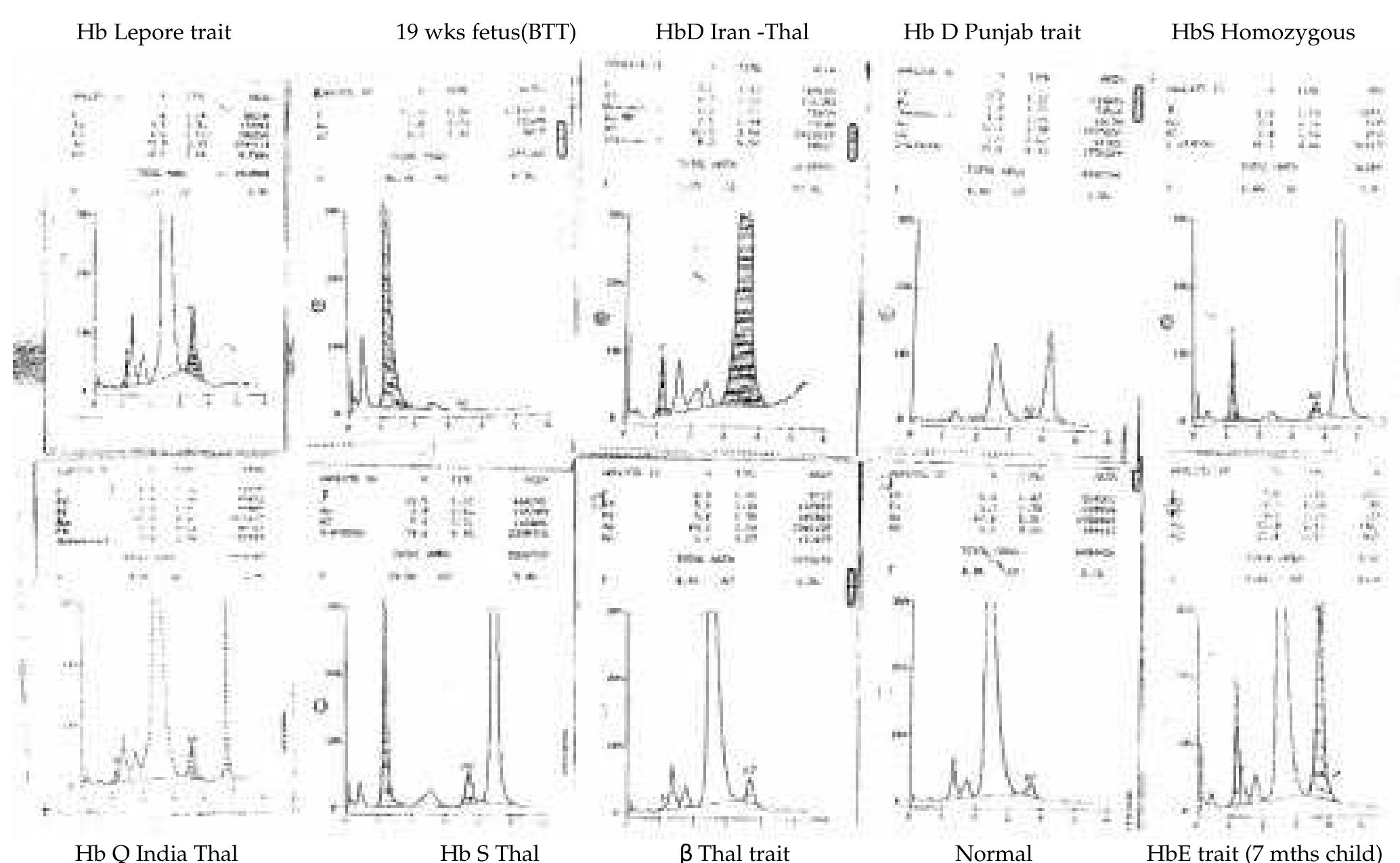 Ce-hplc chromatograms of some hemoglobin variants seen in