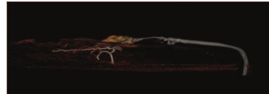 S 1-2. four dimensional ct-angiography of alt flap