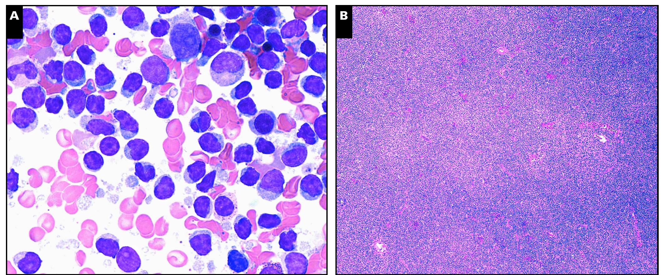 (PDF) Chronic Lymphocytic Leukemia FISH Panel: Impact on Diagnosis