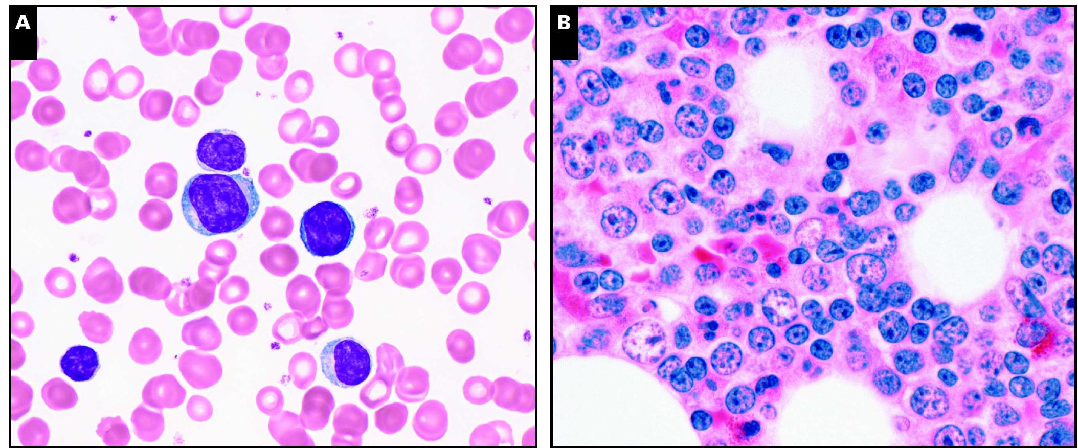 (PDF) Chronic Lymphocytic Leukemia FISH Panel: Impact on Diagnosis
