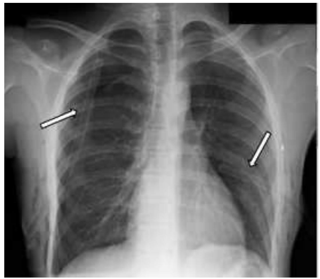 Postero-anterior radiograph of the chest shows interval