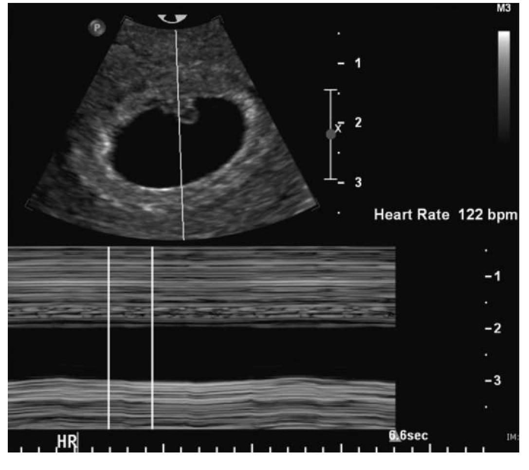 Acnormal Usg Week Figure 7 - Normal and Abnormal US Findings in Early