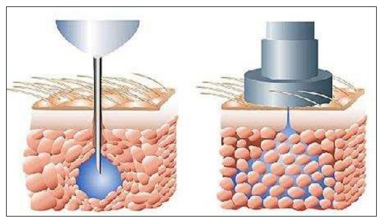 How Work Needle Free Injection (PDF) NEEDLE FREE INJECTION SYSTEM: A REVIEW