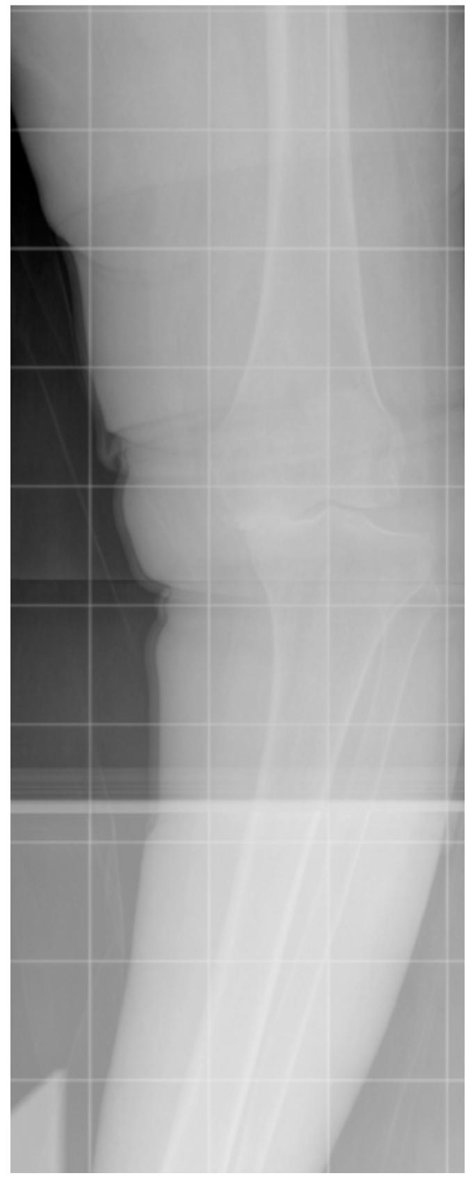 Varus Defor (PDF) The relevance of ligament balancing in total knee arthroplasty ...
