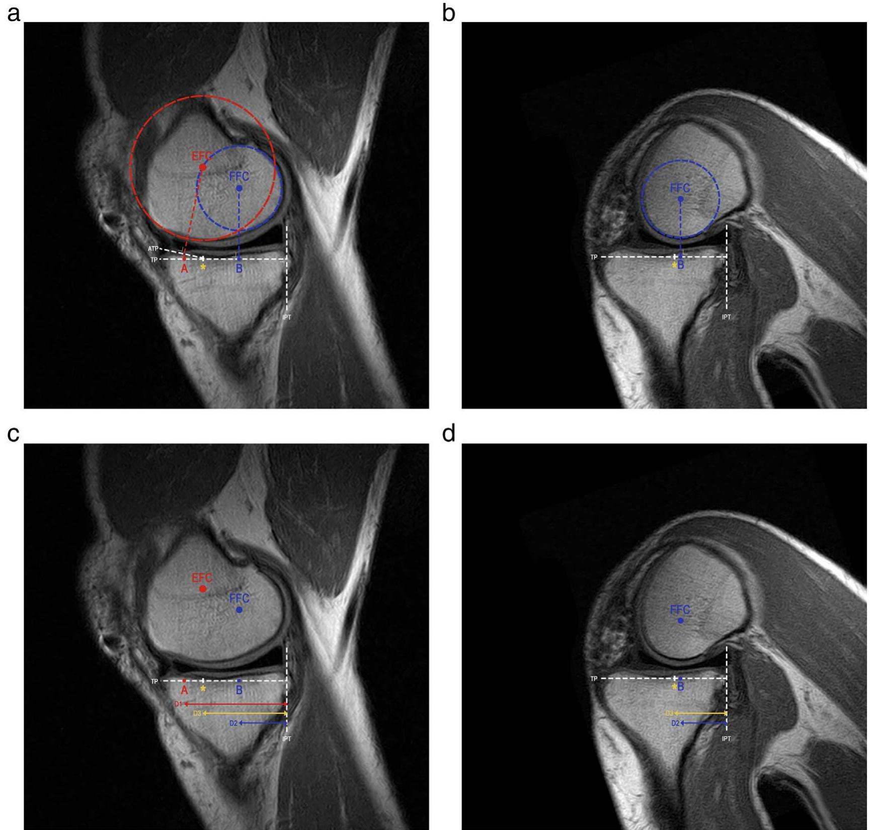 Mr-images of the medial compartment at 0° (a) and 120° knee