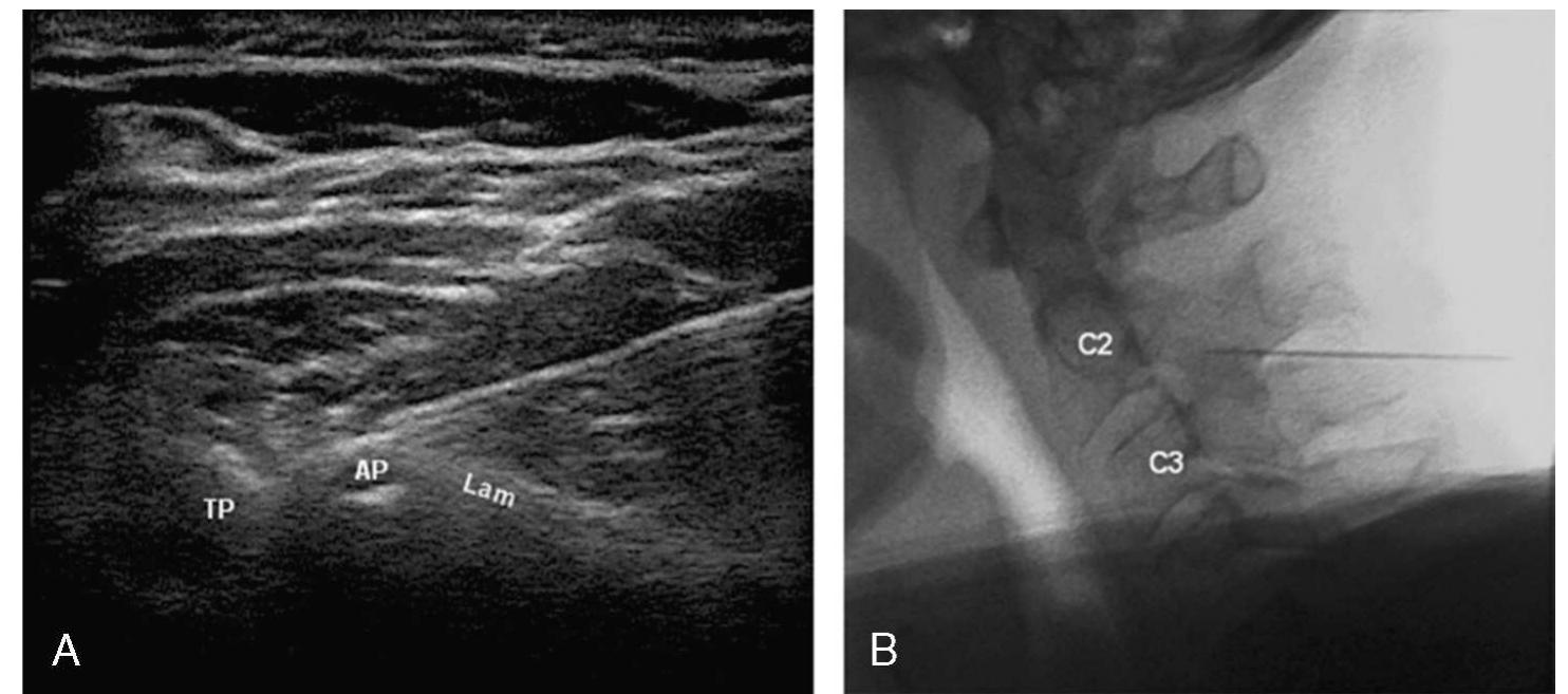 (PDF) A randomized comparison between ultrasound- and fluoroscopy ...