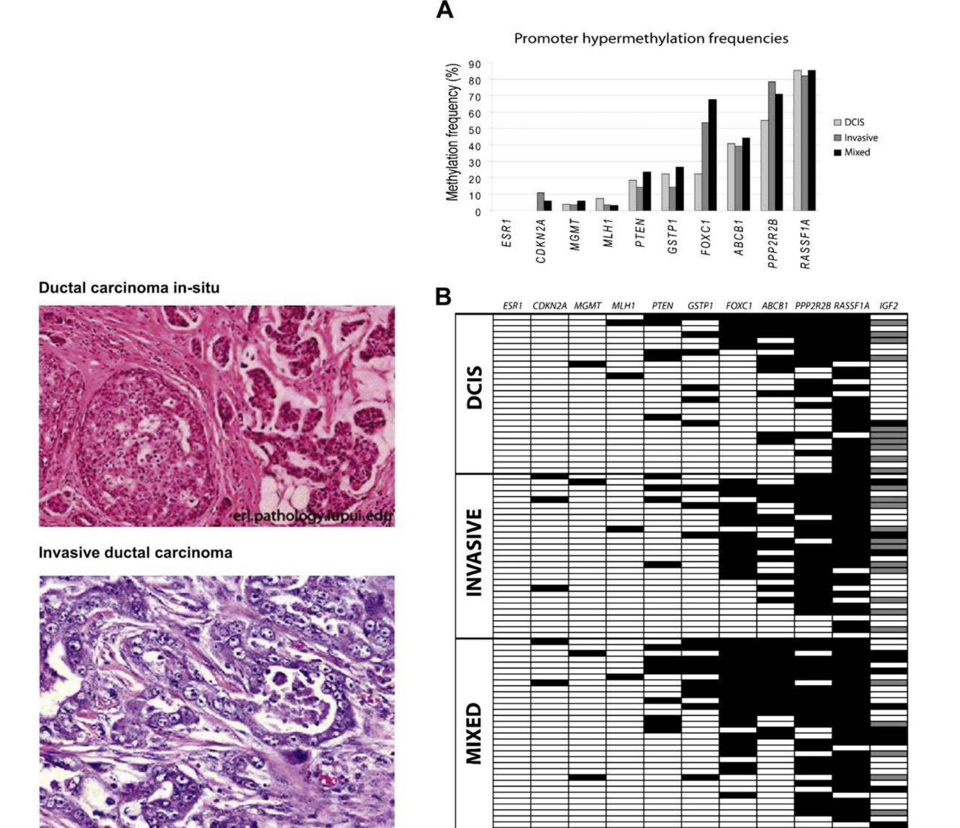 the most common histopathological types of breast cancer