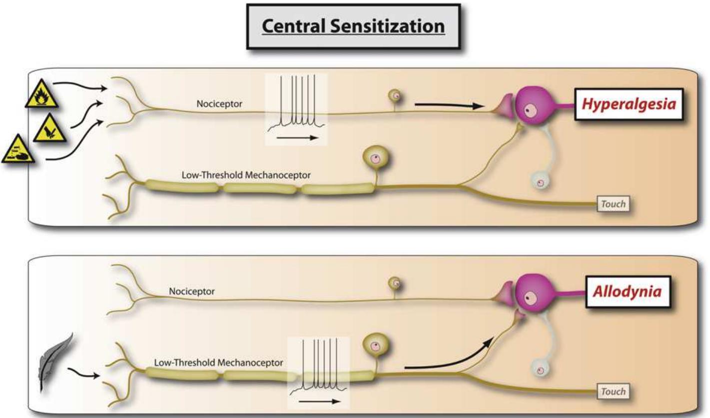 (PDF) Woolf 2011 Central sensitization