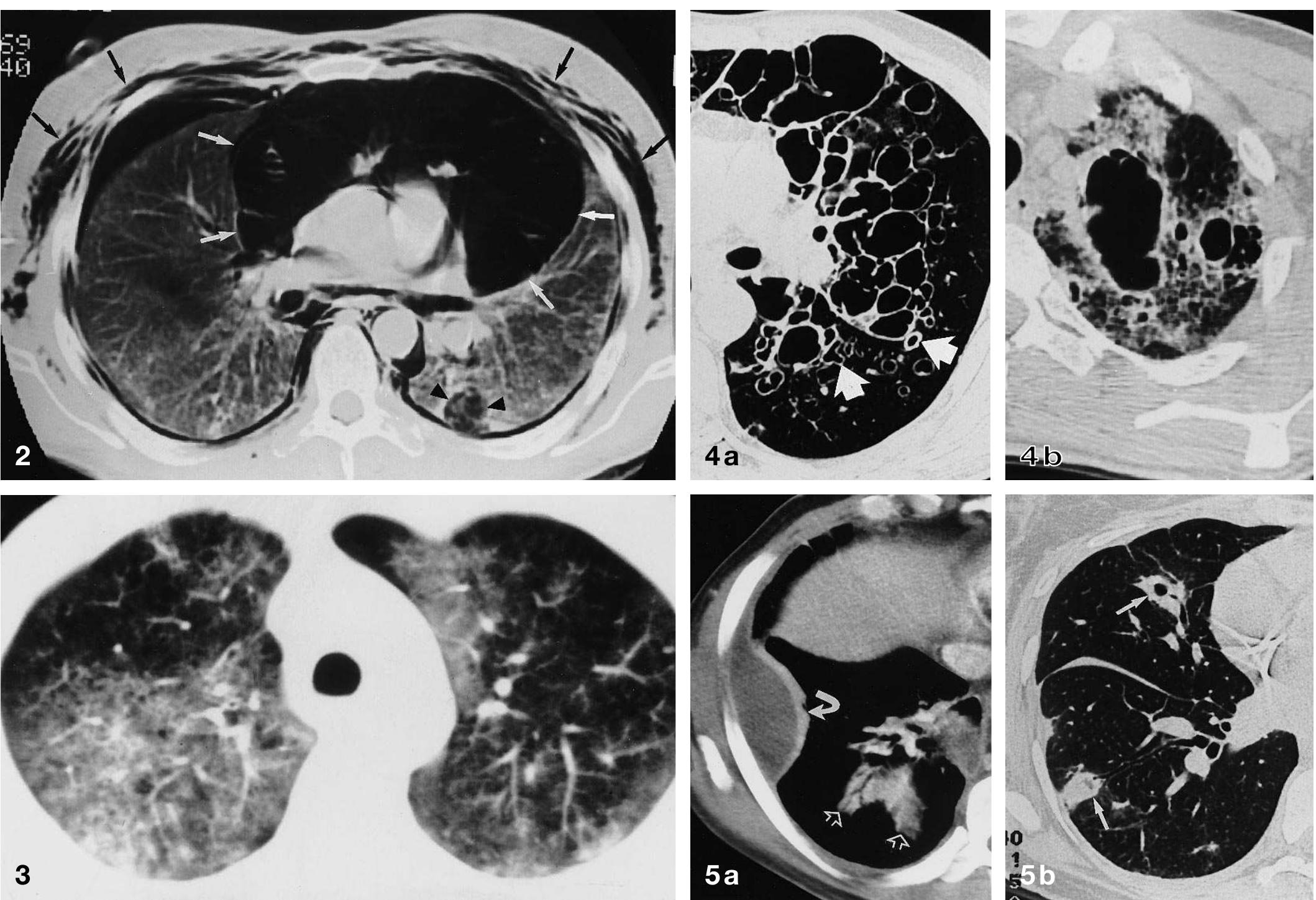(PDF) Computed tomography of the thorax in HIV disease
