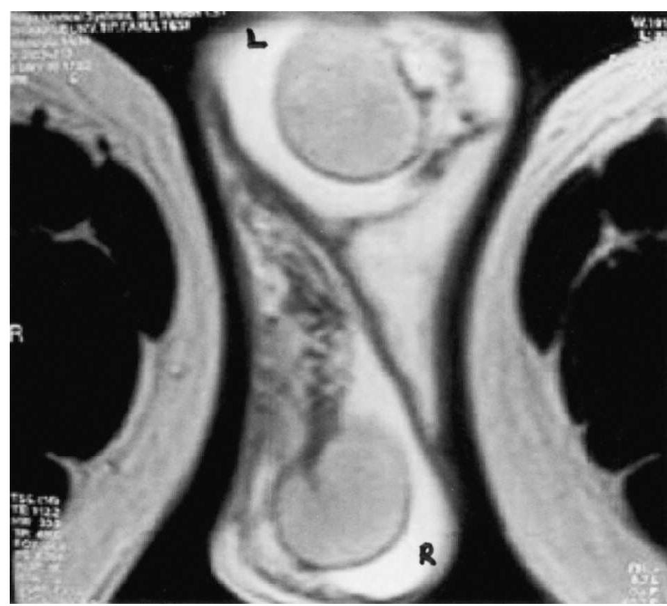 Macroscopic view of bilateral testicular and scrotal
